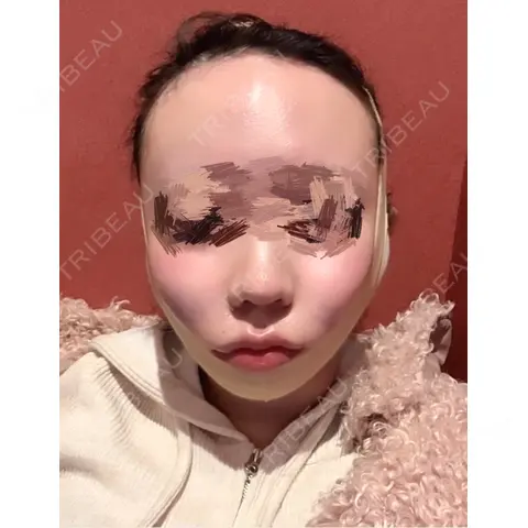 脂肪吸引（顔） / ヒアルロン酸注入（唇） / ボトックス（口角） / ボトックス（人中） ルラ美容クリニック 新宿院 DAY 0