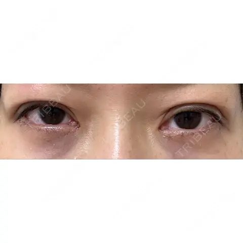 二重埋没 / クマ治療 / 下まぶたの脂肪取り / 脂肪注入（目の下） 湘南美容クリニック 西葛西院 DAY 0