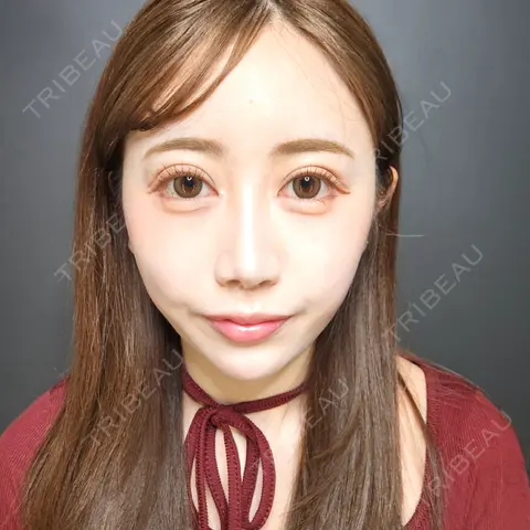 二重埋没 / 目頭切開 / 目尻切開 Tokyo Tensei Clinic 新宿院 AFTER