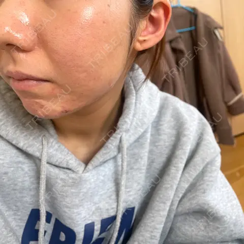 ニードルRF（ポテンツァなど） / ポテンツァ / その他（肌） ゆきスキンクリニック 東池袋 AFTER