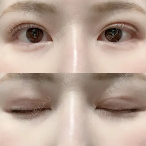 二重埋没 WOM CLINIC GINZA （ワム クリニック ギンザ） AFTER