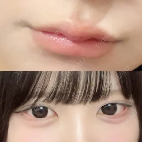 ヒアルロン酸注入（涙袋） / ヒアルロン酸注入（唇） HAAB×DREAM BEAUTY CLINIC 大阪梅田院 AFTER
