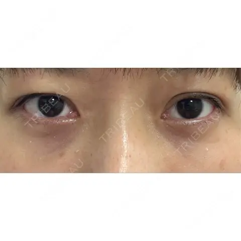 二重埋没 / クマ治療 / 下まぶたの脂肪取り / 脂肪注入（目の下） 湘南美容クリニック 西葛西院 AFTER