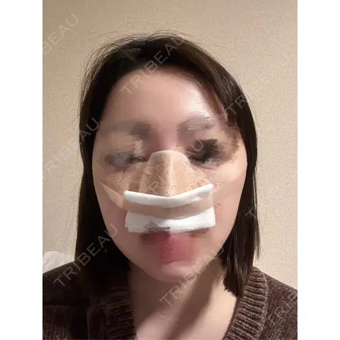 隆鼻術 / 鼻尖形成（切開） / 鼻中隔延長（切開） / 軟骨移植 / 鼻孔縁挙上 / 鼻孔縁下降 / 鼻翼基部形成（貴族手術） / その他（鼻） Designo Clinic （デジーノクリニック） DAY 1