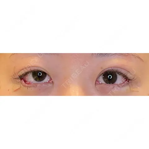 目尻切開 / タレ目形成・グラマラスライン（埋没） / 美容点滴・美容注射（美肌） LOUIS CLINIC 二子玉川院【ルイクリニック】 DAY 0