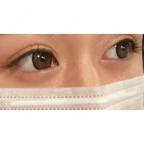 二重切開 オーキッド美容クリニック東京御徒町 AFTER