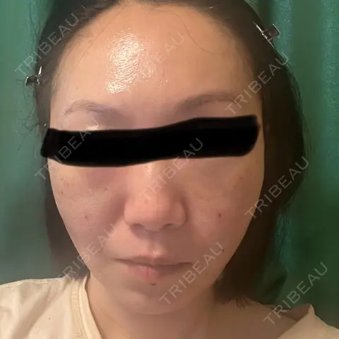 糸リフト / クマ治療 / 下まぶたの脂肪取り / 脂肪注入（肌） / こめかみ形成 / 脂肪注入（目の下） / ボトックス（あご） / ボトックス（首） 東京シンデレラ美容外科 池袋院 DAY 1