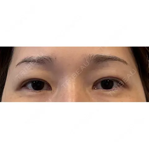 二重埋没 WOM CLINIC GINZA （ワム クリニック ギンザ） DAY 0