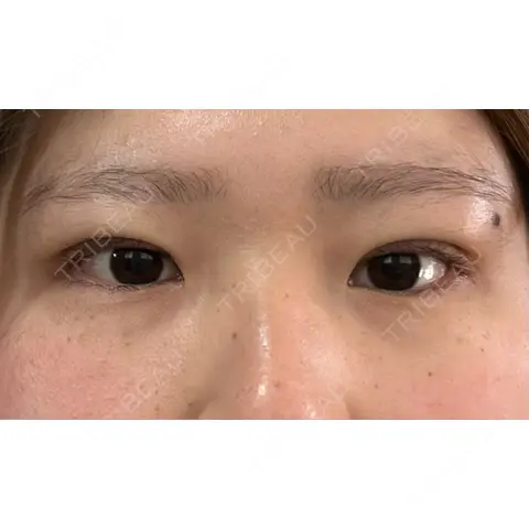 二重埋没 アリエル美容クリニック 大宮院 DAY 0