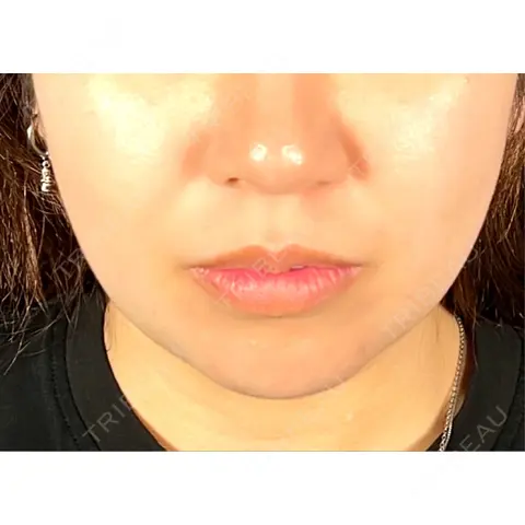 脂肪吸引（顔） R Beauty CLINIC 大阪院 AFTER