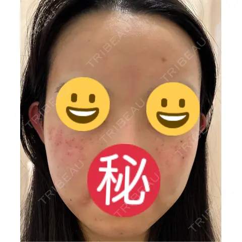エレクトロポレーション / ルメッカ ゆきスキンクリニック 東池袋 DAY 0