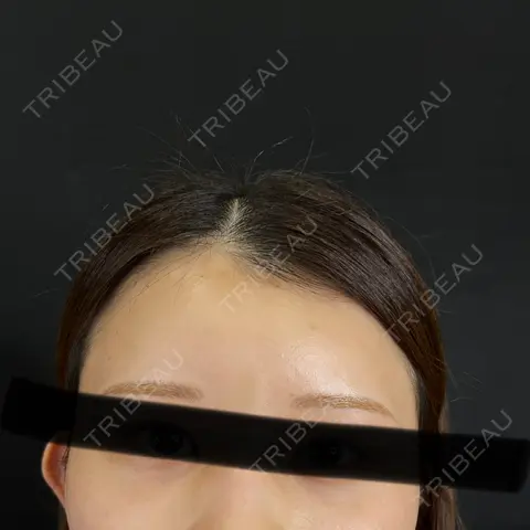 ヒアルロン酸注入（額） 藤・ナチュレ美容クリニック 銀座院 AFTER