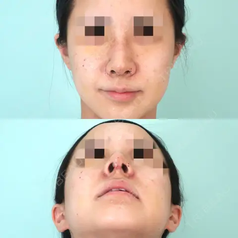 鼻尖形成（切開） / 鼻中隔延長（切開） / 小鼻縮小（切開） / 軟骨移植 / 骨切幅寄せ / ワシ鼻修正・ハンプ切除 / 鼻翼基部形成（貴族手術） / 鼻柱下降・鼻唇角形成（猫手術） / その他（鼻） WOM CLINIC GINZA （ワム クリニック ギンザ） DAY 7