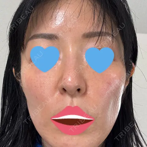 水光注射（ハリ・美肌） / 肌育注射（ジュベルックなど） DAILY SKIN CLINIC 新宿院 DAY 0