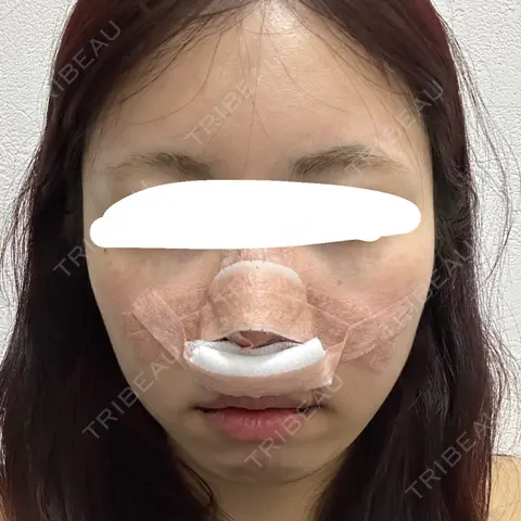 軟骨移植 / 鼻尖縮小 / 鼻翼基部形成（貴族手術） 東京シンデレラ美容外科 新宿院 DAY 0