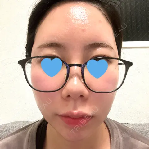 ヒアルロン酸注入（こめかみ） DMTC美容皮膚科 渋谷院 DAY 0