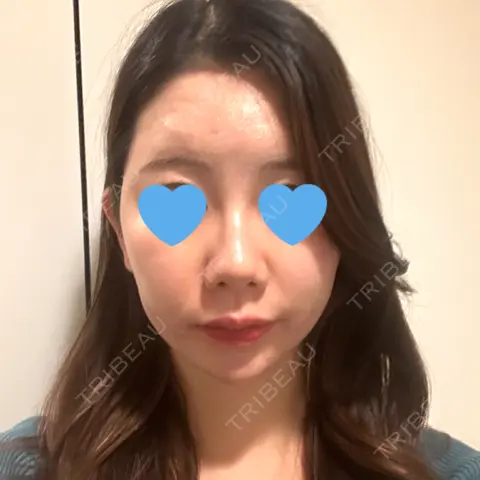 ヒアルロン酸注入（こめかみ） DMTC美容皮膚科 渋谷院 AFTER