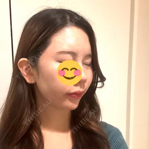 ヒアルロン酸注入（こめかみ） DMTC美容皮膚科 渋谷院 AFTER