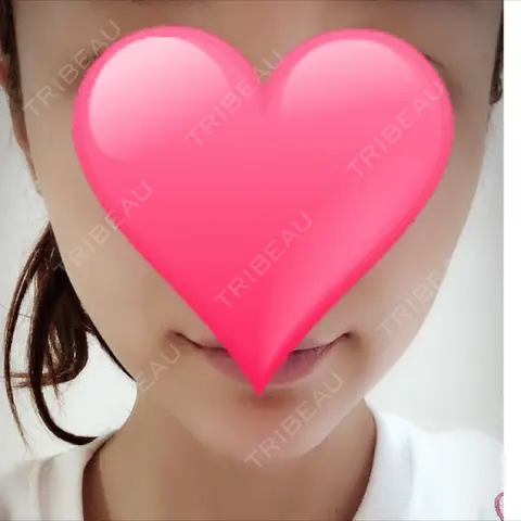 あごプロテーゼ ジュエリー美容外科 AFTER