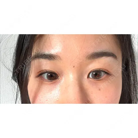 糸リフト / クマ治療 / 下まぶたの脂肪取り LE CLINIC AFTER