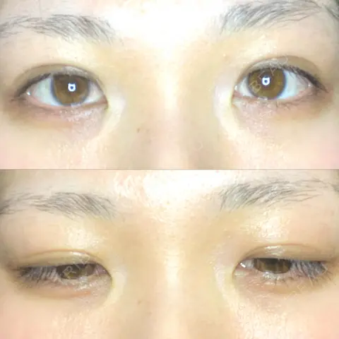 二重埋没 / 自然癒着法 Brandnew Beauty Clinic AFTER
