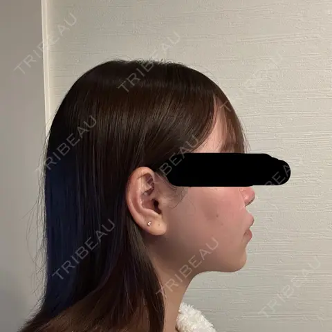 脂肪吸引（顔） / 脂肪吸引注射（顔） SEA CLINIC（シークリニック） AFTER