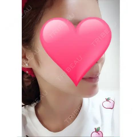 あごプロテーゼ ジュエリー美容外科 AFTER