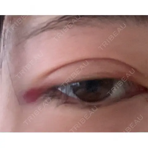 二重埋没 / 目頭切開 HAAB BEAUTY CLINIC 名古屋院 DAY 3