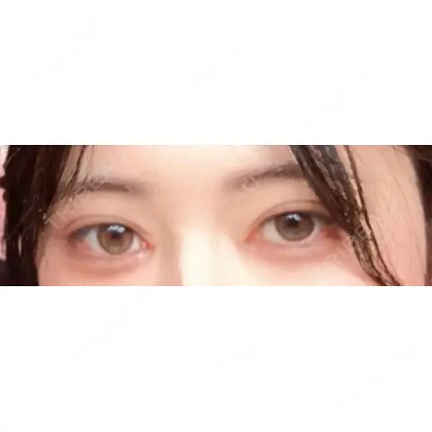 二重埋没 / 目頭切開 HAAB BEAUTY CLINIC 名古屋院 AFTER