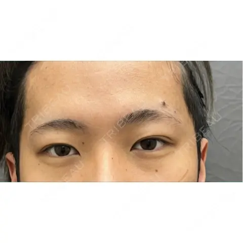 二重埋没 渋谷の森クリニック AFTER
