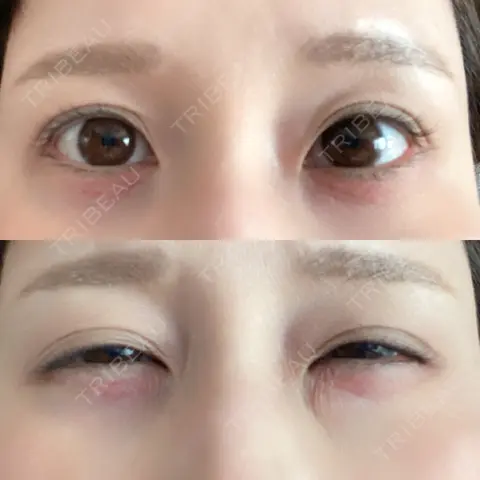ヒアルロン酸溶解 HAAB×DREAM BEAUTY CLINIC 東京本院 DAY 0