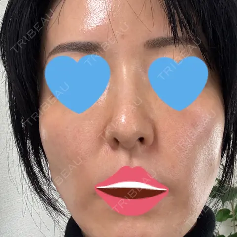 水光注射（ハリ・美肌） / 肌育注射（ジュベルックなど） DAILY SKIN CLINIC 新宿院 AFTER