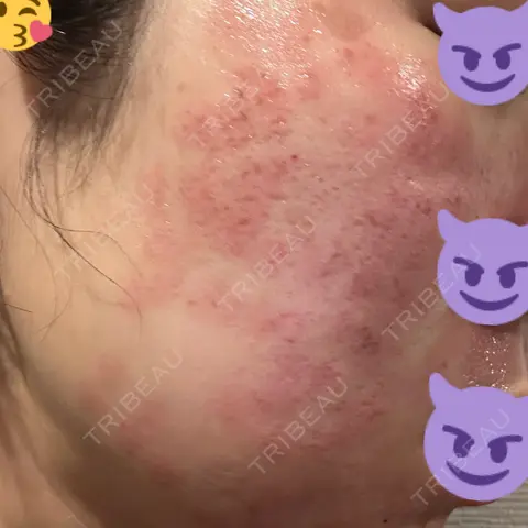 肌育注射（ジュベルックなど） / シミ取りレーザー ゆきスキンクリニック 東池袋 DAY 0