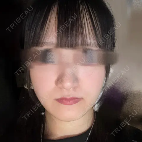骨切り（あご） 銀座マイアミ美容外科 AFTER