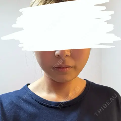 糸リフト / 脂肪吸引（顔） / ジョールファット除去 / 脂肪吸引注射（顔） / ボトックス（エラ・小顔） SEA CLINIC（シークリニック） DAY 1