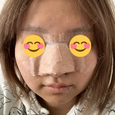 鼻尖形成（切開） / 鼻中隔延長（切開） / 小鼻縮小（切開） / 軟骨移植 / 鼻柱下降・鼻唇角形成（猫手術） 4Dクリニック DAY 1