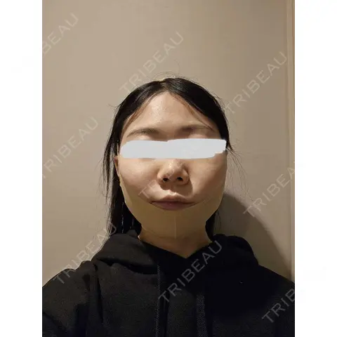 糸リフト / 脂肪吸引（顔） / ジョールファット除去 / 脂肪吸引注射（顔） SEA CLINIC（シークリニック） DAY 0