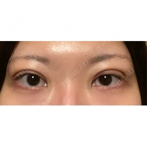 二重埋没 / 上まぶたの脂肪取り 藤・ナチュレ美容クリニック 銀座院 DAY 0