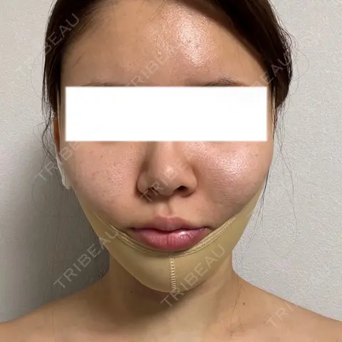 糸リフト / 脂肪吸引（顔） / メーラーファット除去 / ジョールファット除去 / 脂肪吸引注射（顔） SEA CLINIC（シークリニック） DAY 1