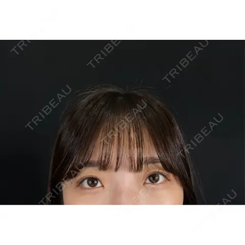 クマ治療 / 下まぶたの脂肪取り / 脂肪注入（目の下） 藤・ナチュレ美容クリニック 銀座院 AFTER