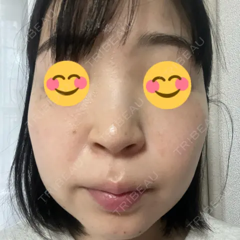 シミ取りレーザー / ピコレーザートーニング（美白・肝斑） / ルビーレーザー / レーザートーニング（美白・肝斑） / その他（肌） ゆきスキンクリニック 東池袋 DAY 1