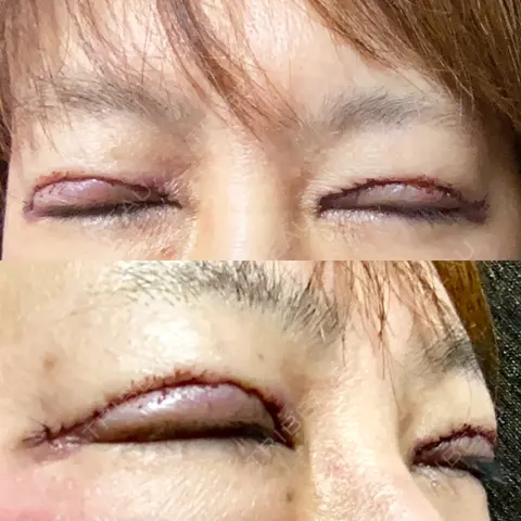 眼瞼下垂（切開） 博多もへじのクリニック DAY 0