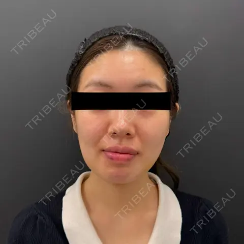 バッカルファット除去 / 脂肪吸引（顔） BLINC CLINIC （ブリンク クリニック） DAY 7