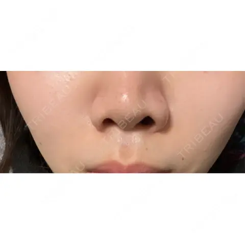 小鼻縮小（非切開） 形成外科と美容外科のクリニック池袋 DAY 0