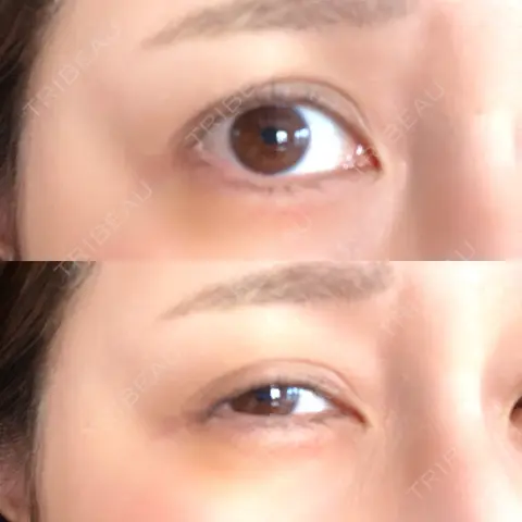 ヒアルロン酸溶解 HAAB×DREAM BEAUTY CLINIC 東京本院 AFTER