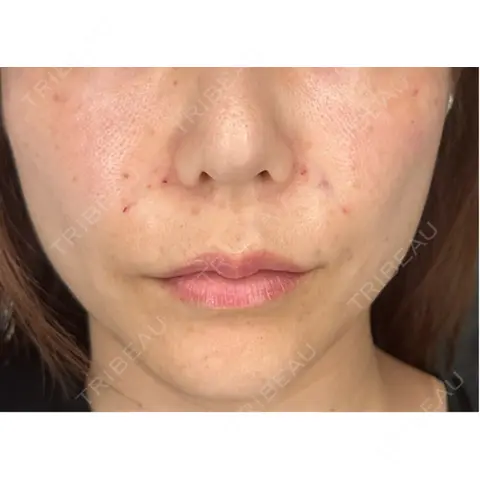 糸リフト / メーラーファット除去 TIAM CLINIC GINZA DAY 0