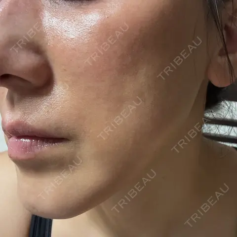 エレクトロポレーション / ルメッカ / その他（肌） ゆきスキンクリニック 東池袋 AFTER