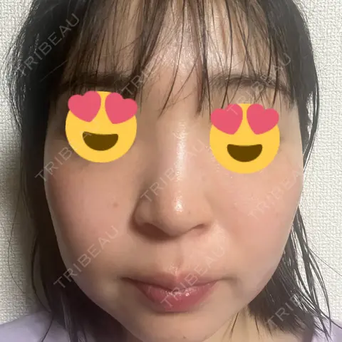 シミ取りレーザー / ピコレーザートーニング（美白・肝斑） / ルビーレーザー / レーザートーニング（美白・肝斑） / その他（肌） ゆきスキンクリニック 東池袋 AFTER