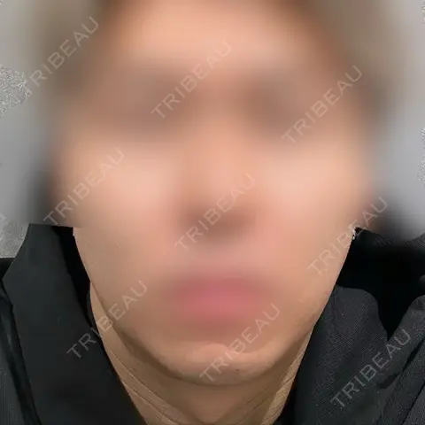 糸リフト / 脂肪吸引（顔） / 脂肪吸引注射（顔） ziz CLINIC DAY 0