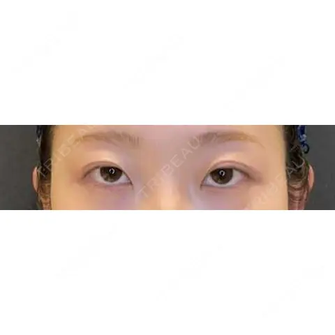 二重埋没 / 目頭切開 LOUIS CLINIC 二子玉川院【ルイクリニック】 AFTER